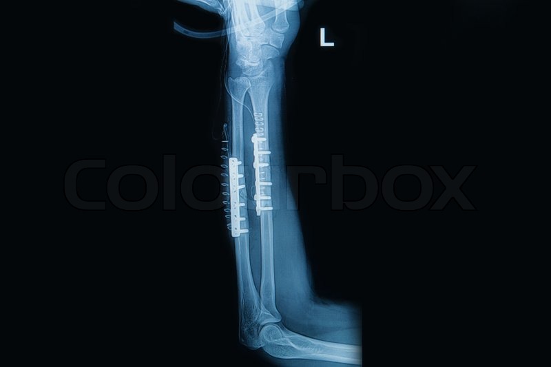 Röntgenbild eines linken Handgelenks mit Fraktur des Radius und der Ulna, sichtbar mit Platte und Schraube.
