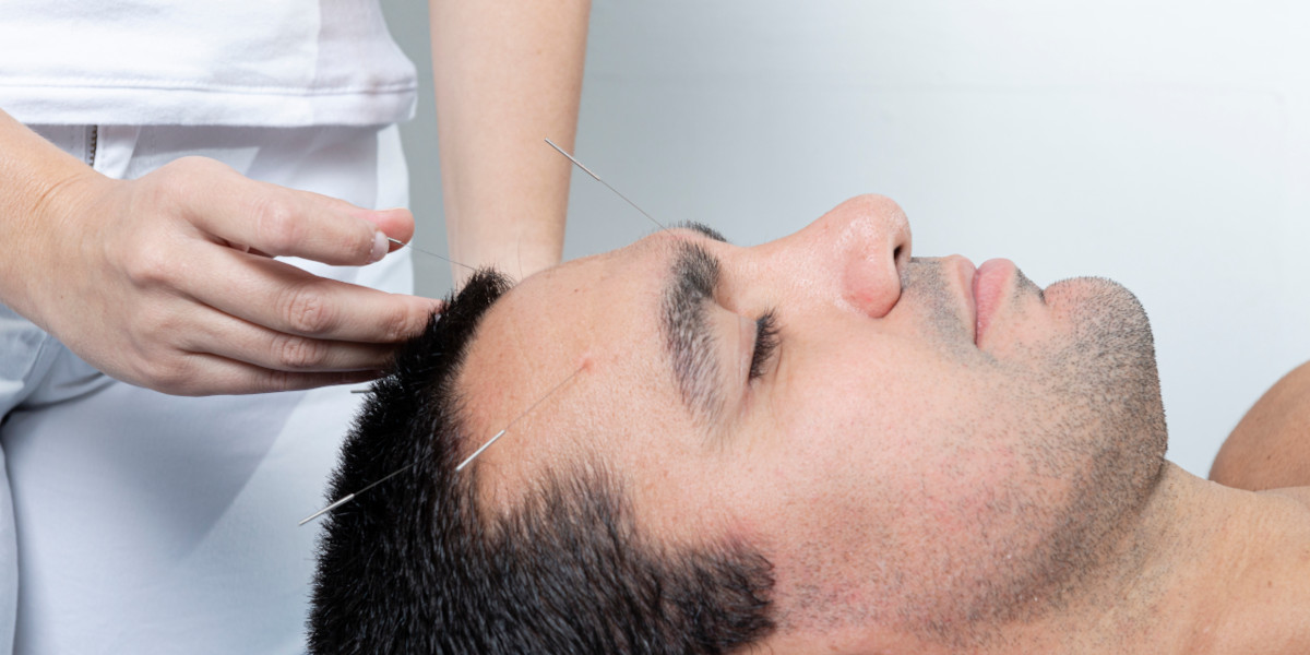 akupunktur Mann liegt auf einer Liege, während eine Person Akupunkturnadeln in seinen Kopf einsetzt.