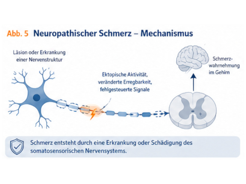 neuropathischer_schmerz Neuropathischer Schmerz entsteht durch Nervenschädigung und veränderte Signale, die über das Rückenmark zum Gehirn gelangen.