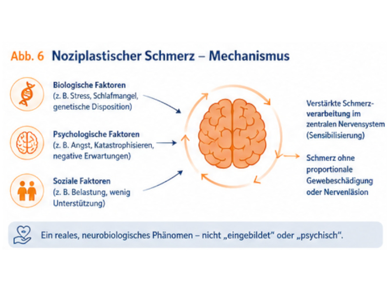 noziplastischer_schmerz Schaubild zeigt biologische, psychologische und soziale Faktoren bei noziplastischem Schmerz sowie zentrale Sensibilisierung.