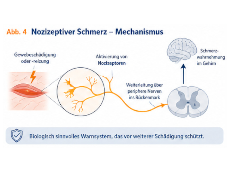 nozizeptiver_schmerz Grafik zum nozizeptiven Schmerz: Gewebereizung aktiviert Nozizeptoren und leitet Signale über Nerven zum Gehirn weiter.