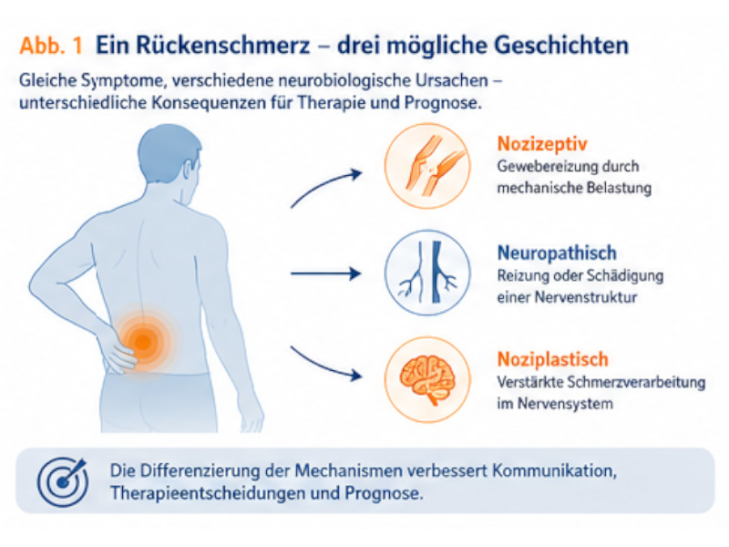 rueckenschmerz_geschichte Grafik zeigt Rückenschmerz mit drei Mechanismen: nozizeptiv, neuropathisch und noziplastisch, mit Folgen für Therapie und Prognose.